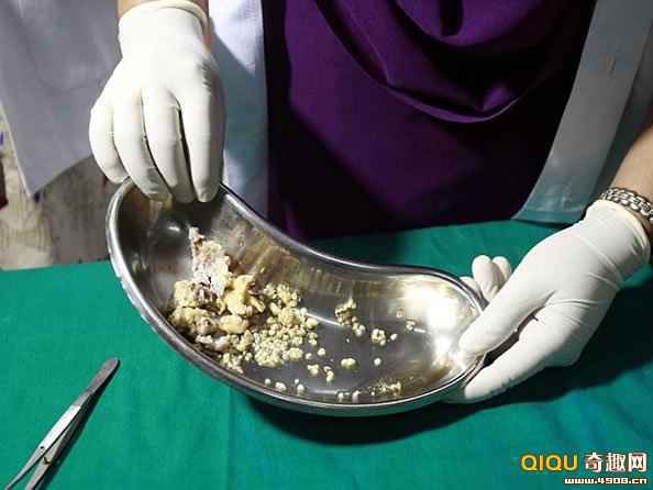 17岁印度少年患罕见牙瘤病_故事吧