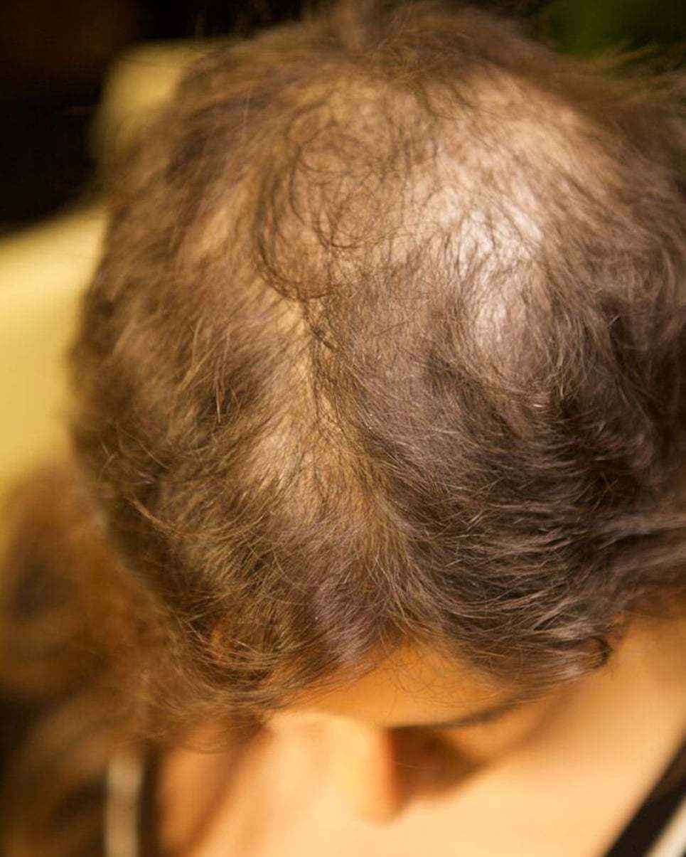 一紧张就忍不住薅头发，“拔毛癖”是病得治……